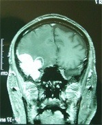 Minimally Invasive Surgery for Brain Tumours