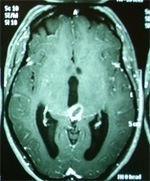 Minimally Invasive Surgery for Brain Tumours
