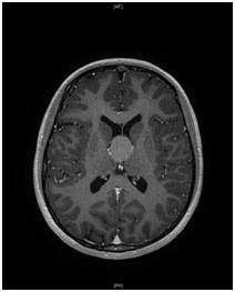 Colloid cysts