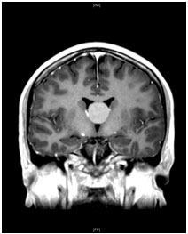 Colloid cysts