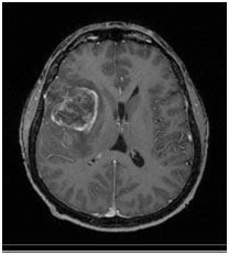 Glioblastoma Multiforme