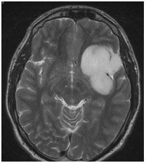 Low grade astrocytoma