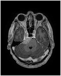 Meningiomas