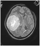 Oligodendrogliomas